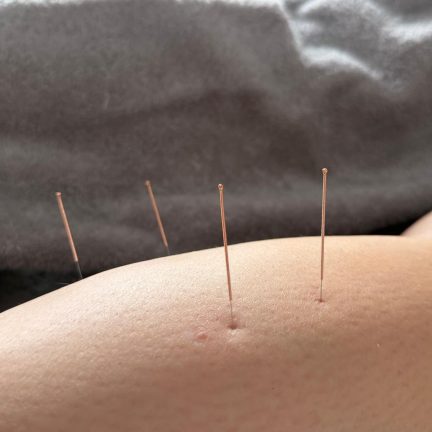 Suzana needles